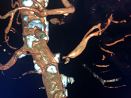 angio-scanner-gauche1